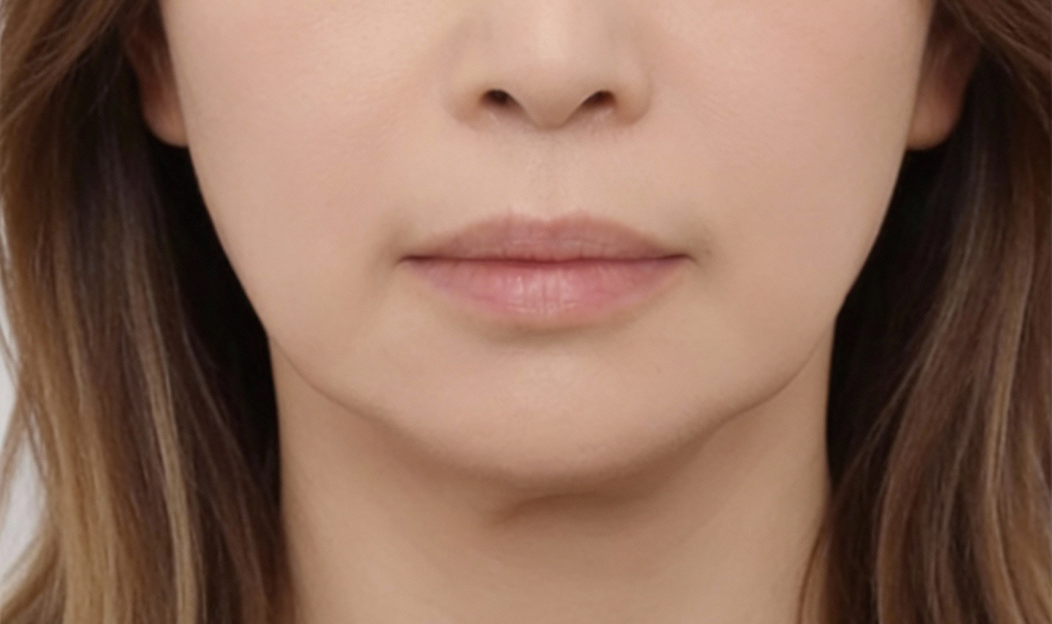 50代女性 フェイスライン たるみ ボトックス施術後