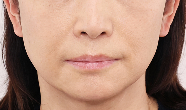 50代女性 フェイスライン たるみ ボトックス施術前