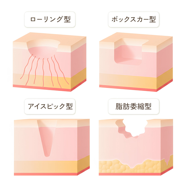 トライフィルプロ（TRIFILL PRO） クレーター状ニキビ跡への作用イメージ