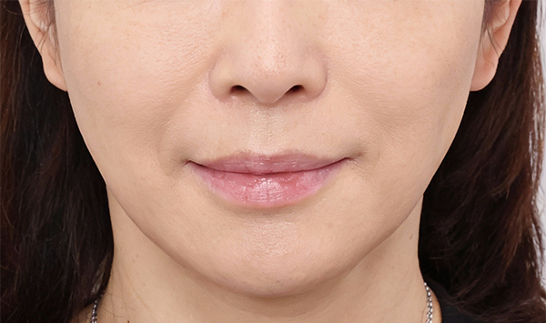 50代女性 フェイスライン たるみ XERF施術後